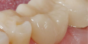 VITA Enamic fogászati CAD/CAM anyaggal készült fogpótlás a szájban