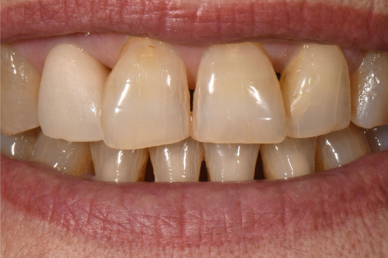 Túl világos fogpótlás az első dentin égetés után