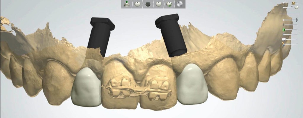 3Shape Implant Studio szoftverben tervezett 3D modell