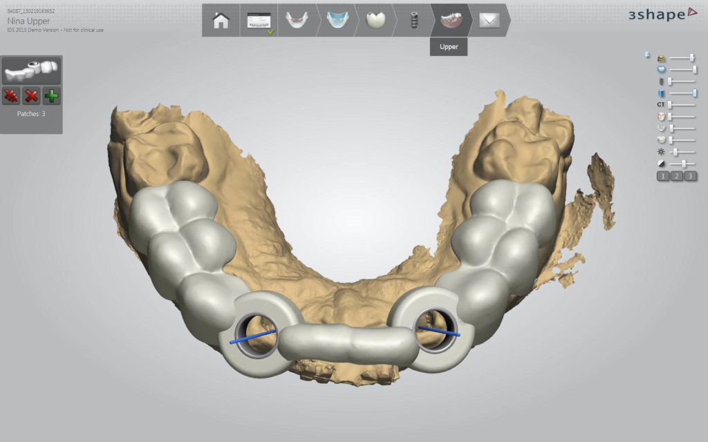 3Shape Implant Studio szoftverben tervezett fúrósablon