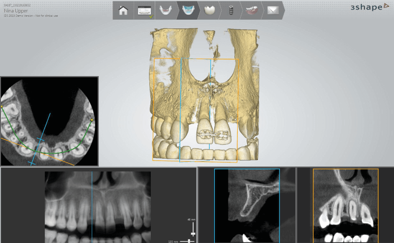 Tervezés Implant Studio tervezőszoftverrel
