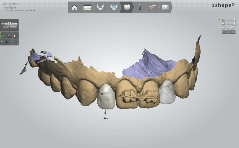 3Shape Implant Studio szoftver anatómikus pótlás tervezése