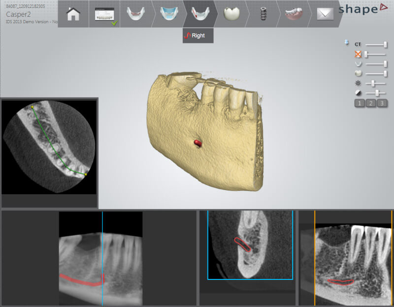 3Shape Implant Studio szoftver tervezési folyamat, gyökér és idegcsatorna definiálás