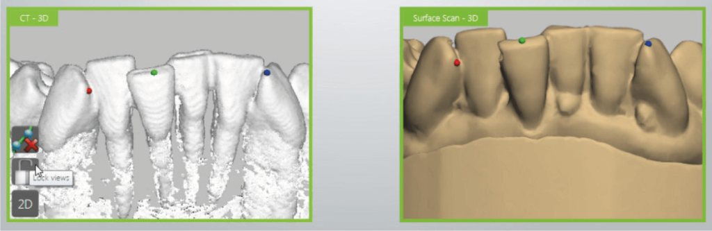 3Shape Implant Studio szoftver tervezési folyamat, illesztési pontok