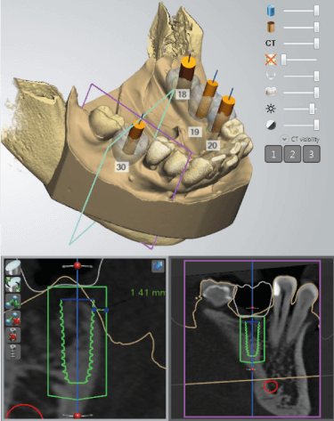 3Shape Implant Studio szoftver tervezési folyamat