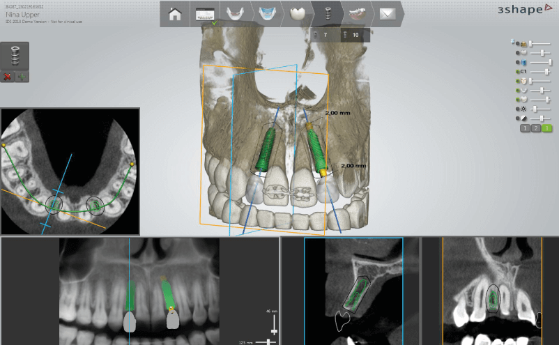3Shape Implant Studio tervezőszoftver tervek ellenőrzése