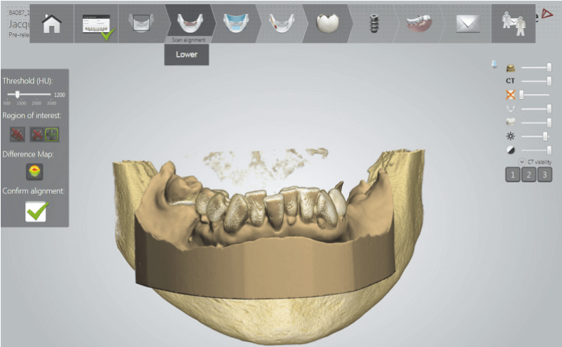 Tervezés Implant Studio tervezőszoftverrel