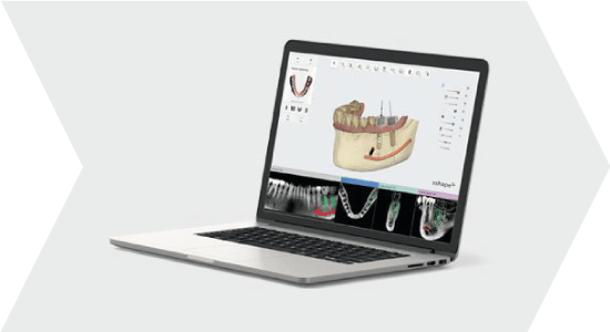 Implantátum tervezés Implant Studio tervezőszoftverrel