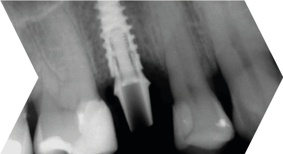 Implantációs műtét