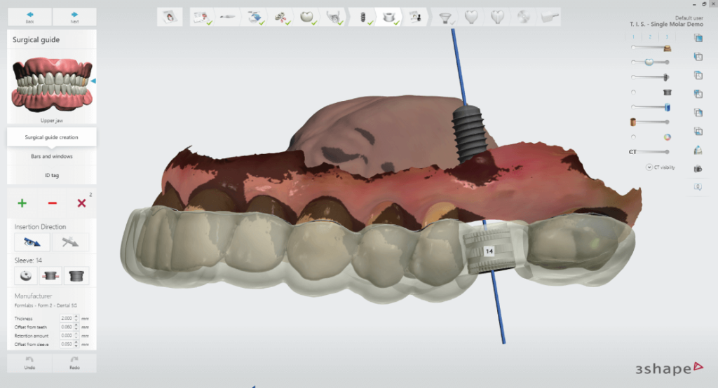 Implant Studioban tervezett fúrósablon