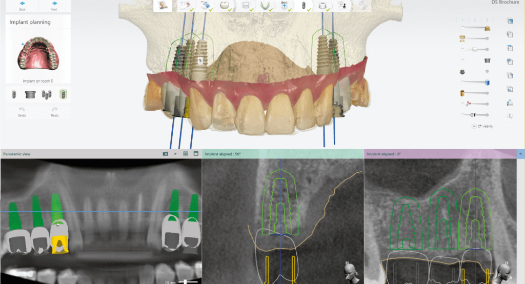 Implantátum tervezés Implant Studio tervezőszoftverben