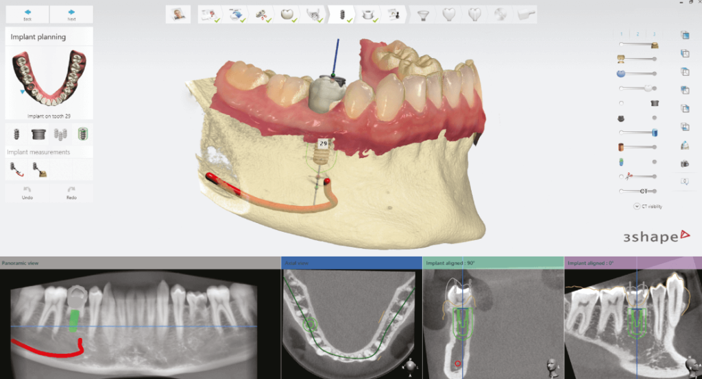 Protetikus implantátumtervezés 3Shape Implant Studio szoftverrel