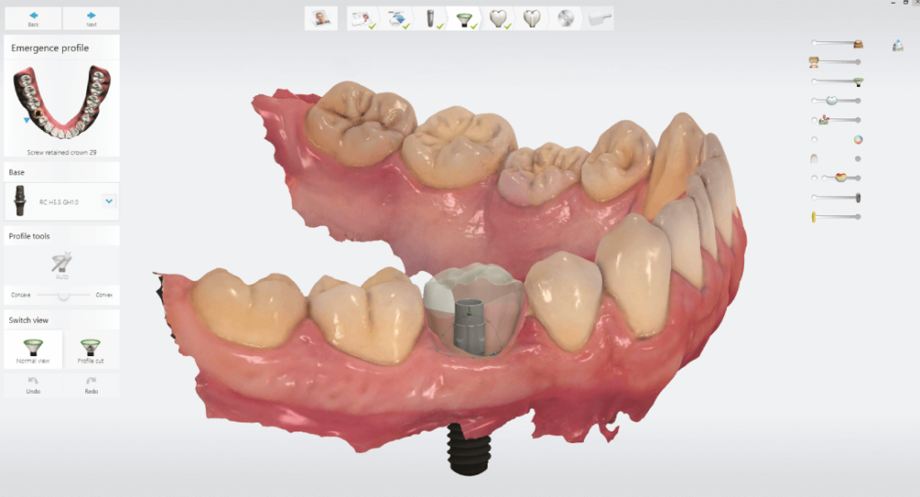 Virtuális fogpótlás tervezés Implant Studioval