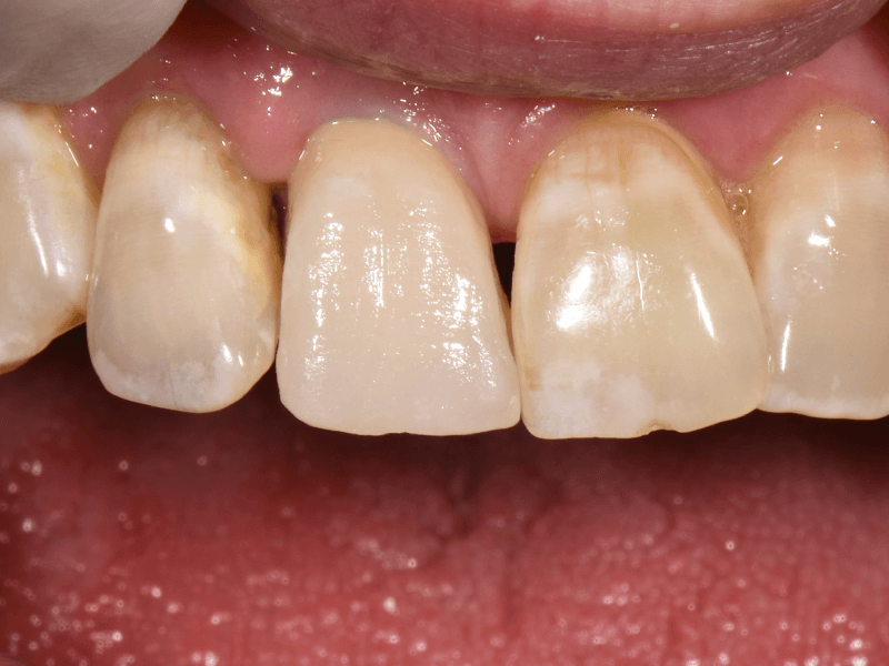 Fogpótlás próba első dentin égetés után
