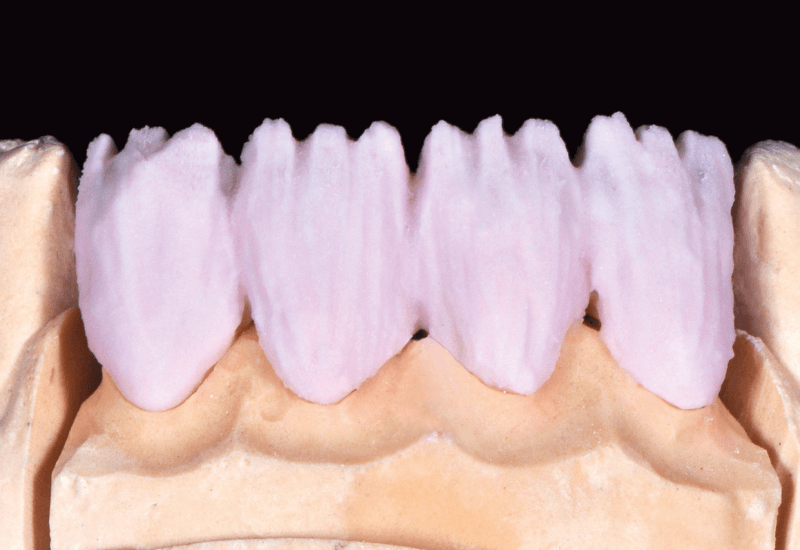A dentin alap kialakítása DENTINE A3- ból
