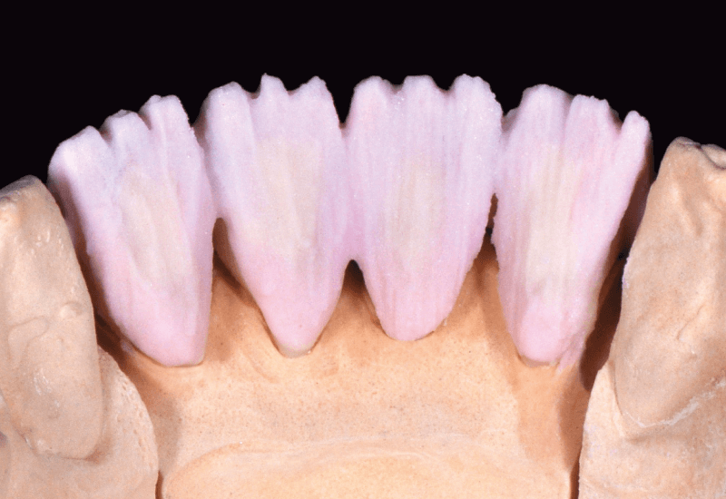 A DENTINE A3,5 és DENTINE MODIFIER copper masszák 50:50 százalékos keverékének elhelyezése palatinálisan