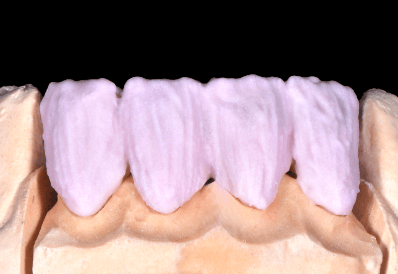 A laterális nyaki intenzitásokat a DENTINE A3,5 és a FLUO INTENSE sand kombinációjának használatával értük el
