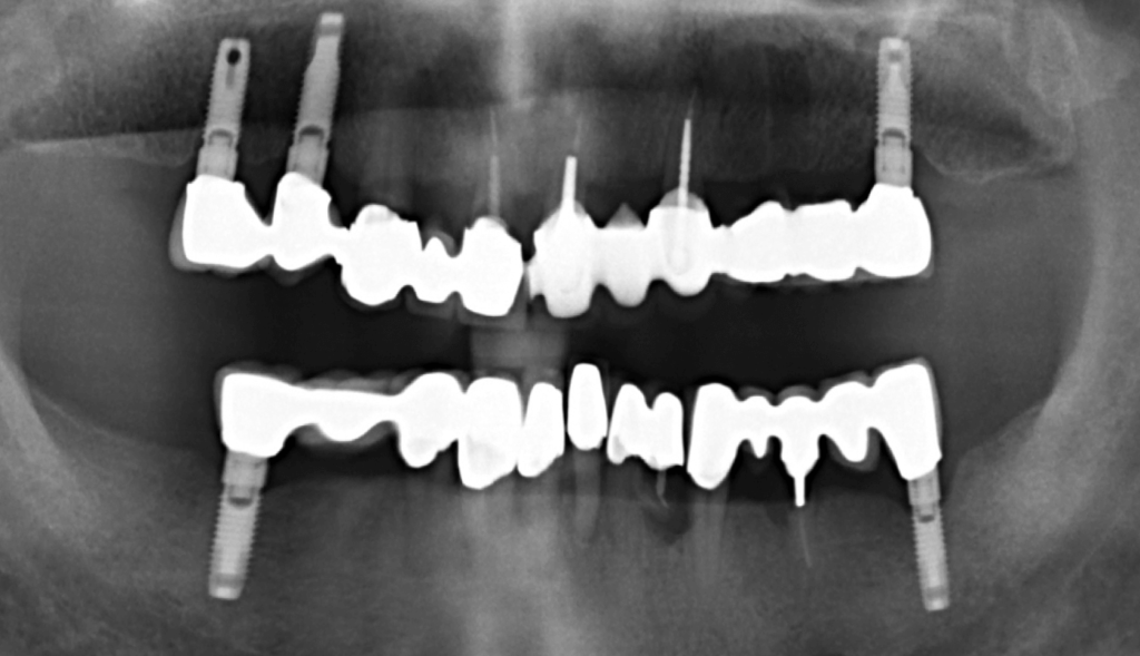 Sikertelen alsó fogpótlás és nagyon régi Steri-Oss implantátumok