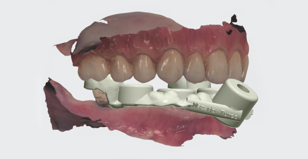 3D fúrósablon tervezés 3shape Implant Studio szoftverrel