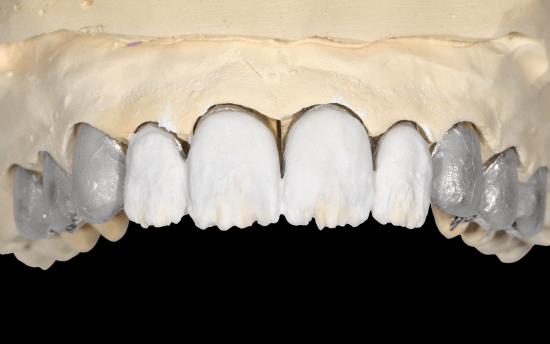 A dentin rétegezése VITA VMK Master LUMINARY 1 (fehér) és VITA VMK Master DENTINE 1M1 masszákkal.