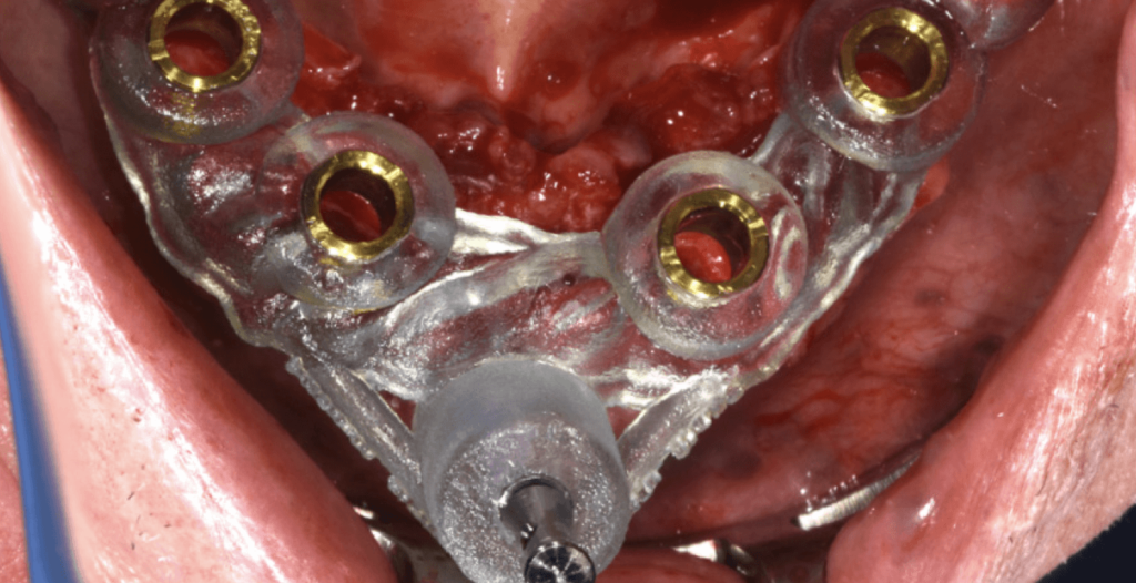 digitálisan tervezett implantációs sebészeti fúrósablon pozícióban