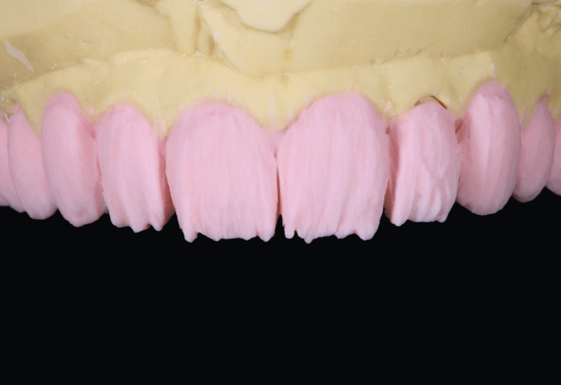Cutback a teljes felszínt borító VITA VMK Master DENTINE A1 felhordása után.
