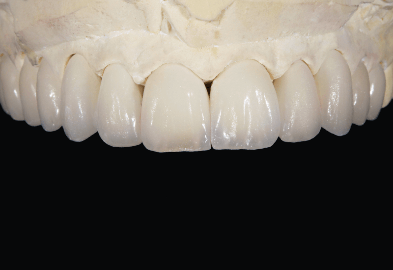 Kiégetés után a teljes felszínre VMK Master DENTINE A1 réteget vittünk fel, majd cutback-et végeztünk
