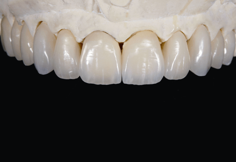 Végül a dentintest világosítása céljából laterálisan és centrálisan VMK Master PLT1 (gyöngyház) réteget alkalmaztunk