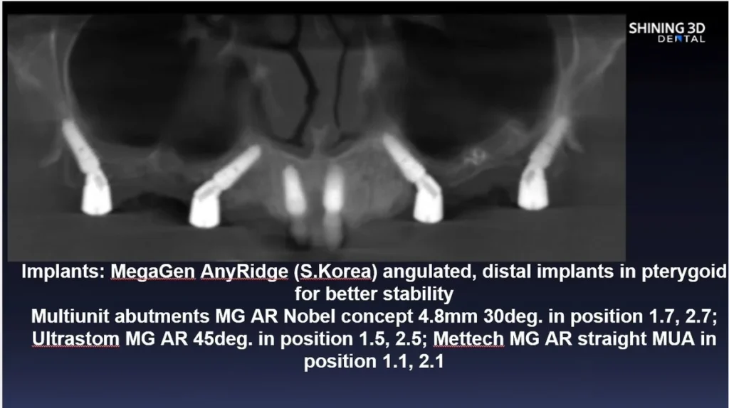 Megan anyridge implantátumok