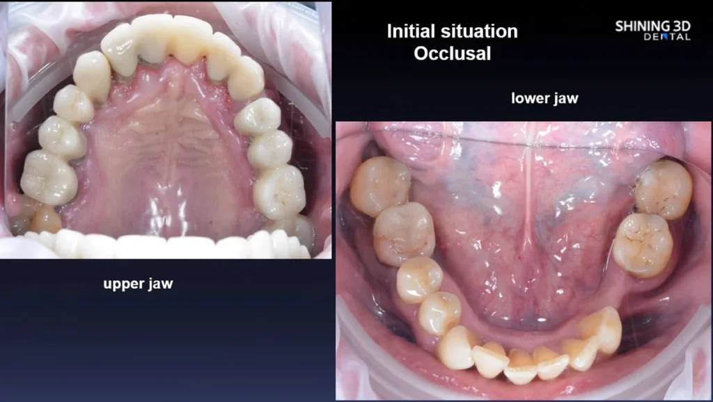 Fogászati eset megoldás Shining Dental
