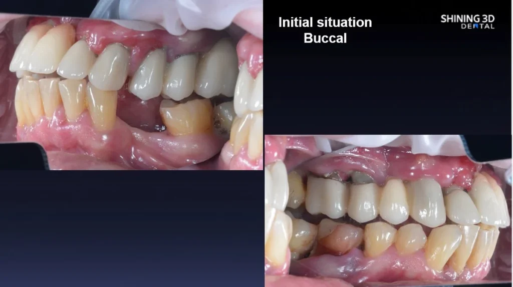 Fogászati eset megoldás Shining Dental oldalról