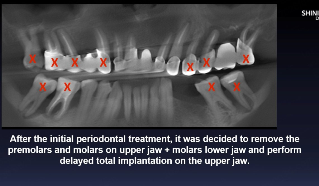 Fogászati eset megoldás Shining Dental röntgenkép jelölések