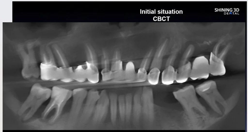 Fogászati eset megoldás Shining Dental röntgenkép szemből