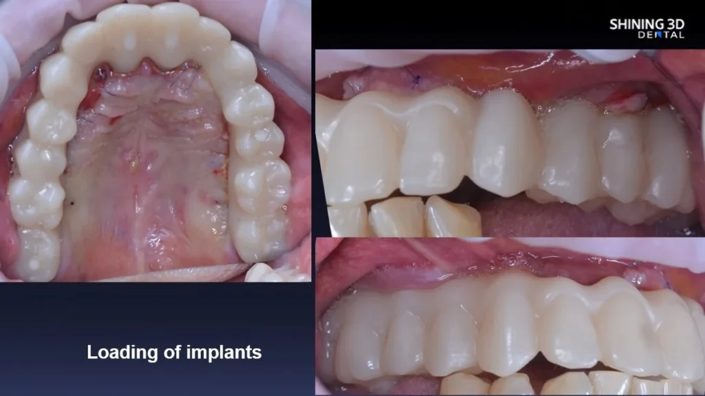 Fogászati nyomtatás és implantátum végeredmény