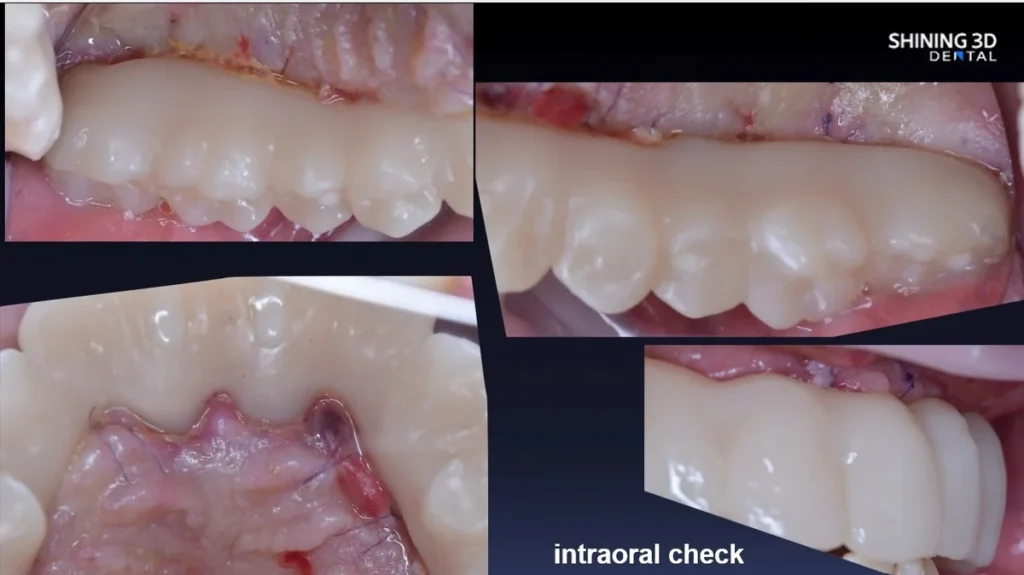 Fogászati nyomtatás és implantátum végeredmény